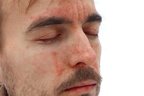 psoriasis en la cara - para qué es la trimebutina